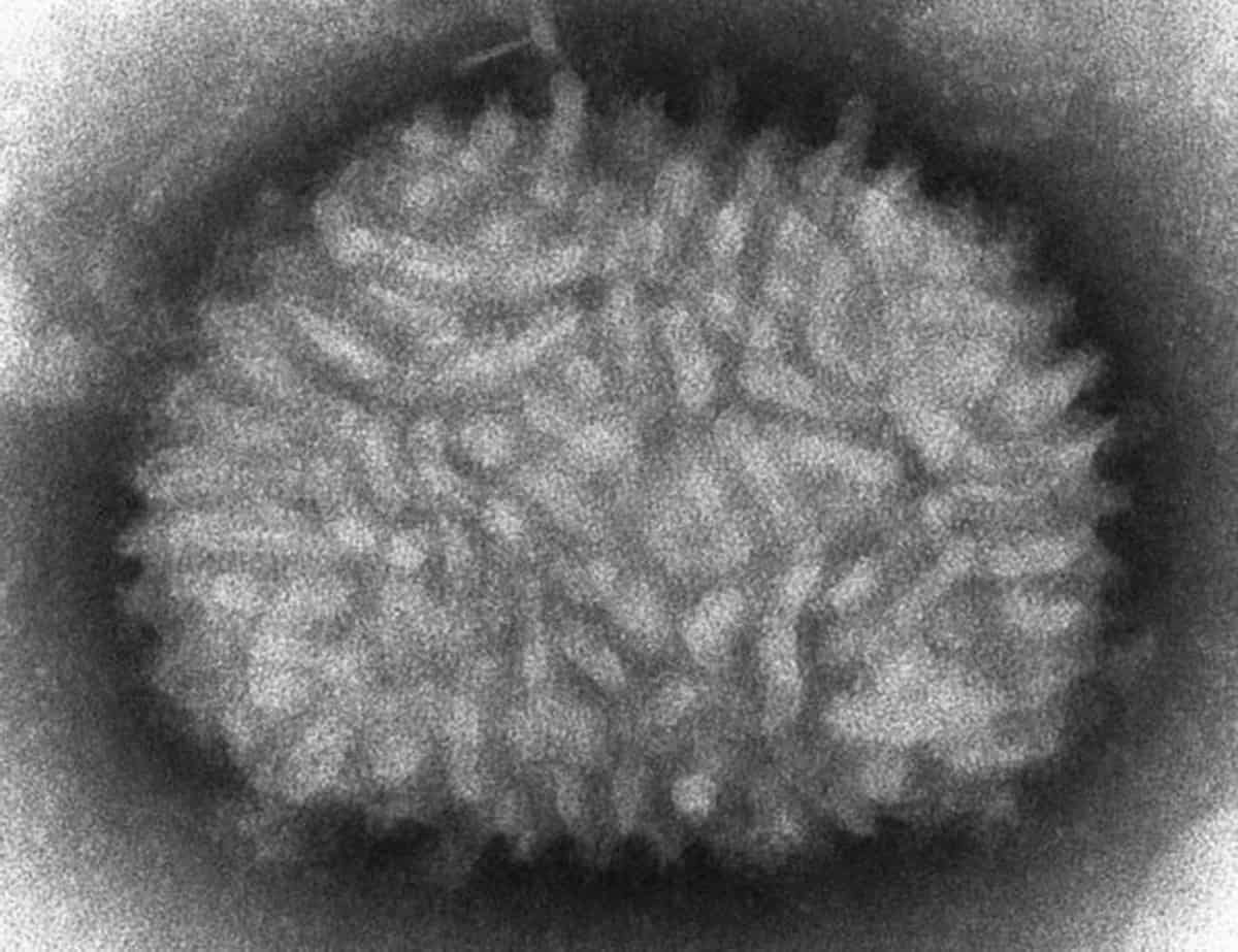 US begins clinical trial to test monkeypox vaccine