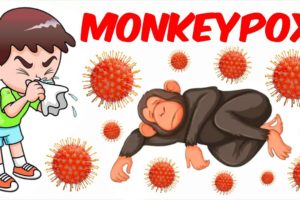 15 cases of monkeypox Quebec