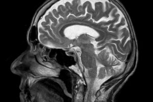 An elderly woman in Russia's Far East was revealed on Wednesday (Oct 4) to have lived for 80 years with an inch-long needle in her brain