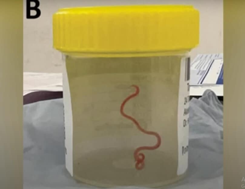 Australian doctors find live parasitic worm in woman's brain