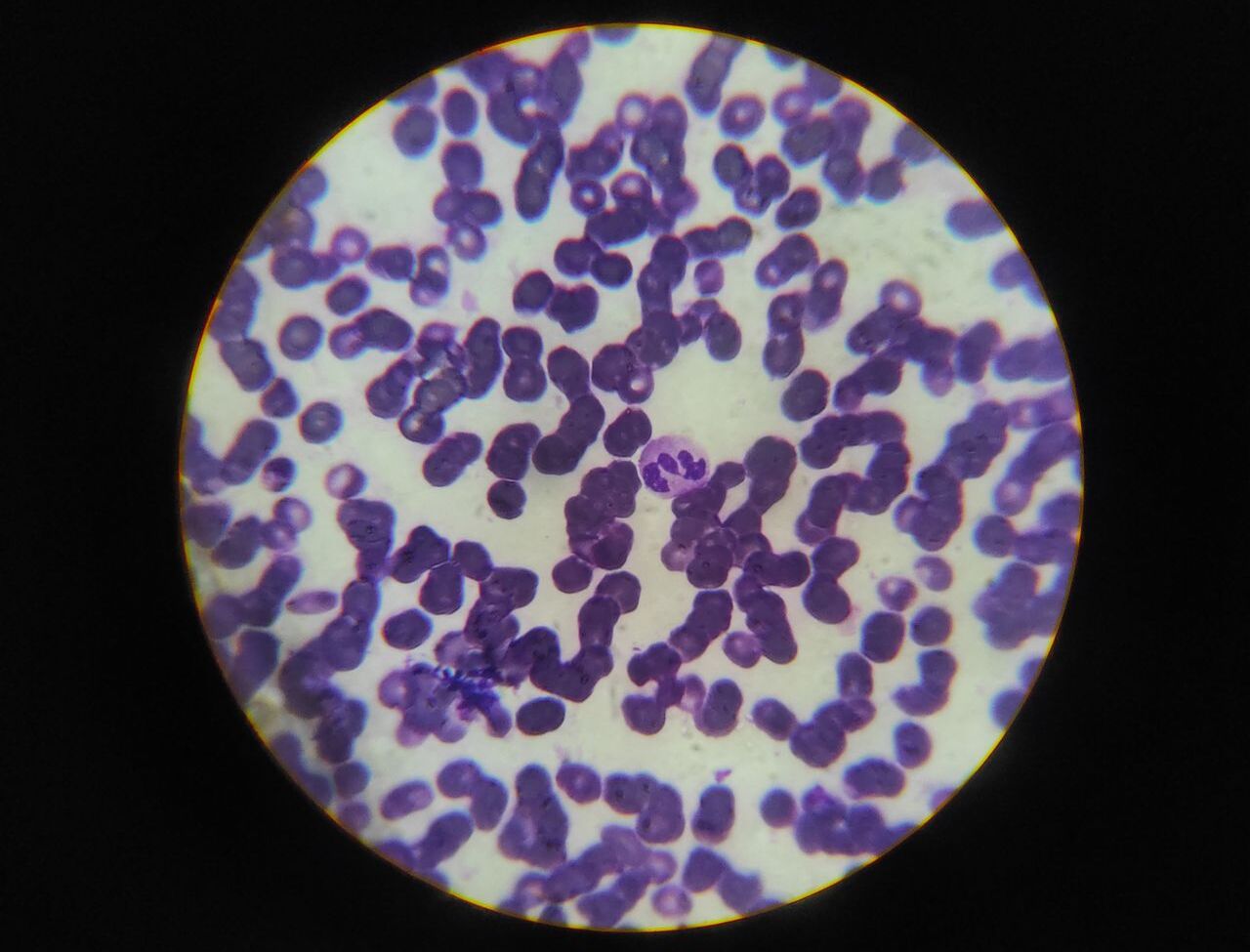 CLL Treatment Drugs Gain Attention as Targeted Therapies Advance